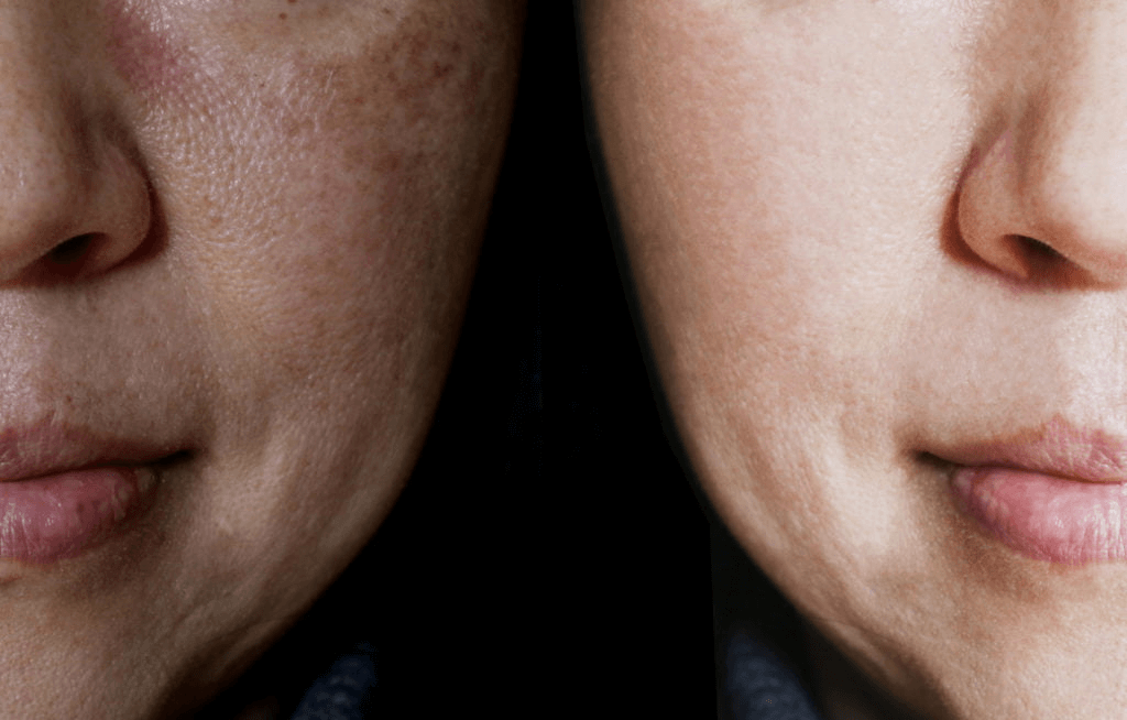 Làn da trước và sau khi trị nám