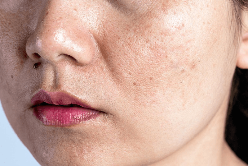 Làn da của phụ nữ bị nám